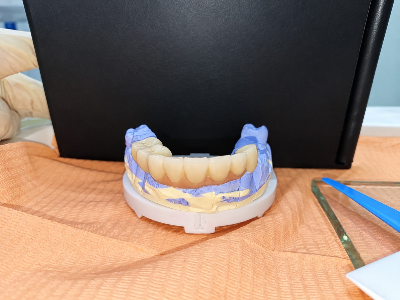 Illustrative dental model photograph; not a patient result